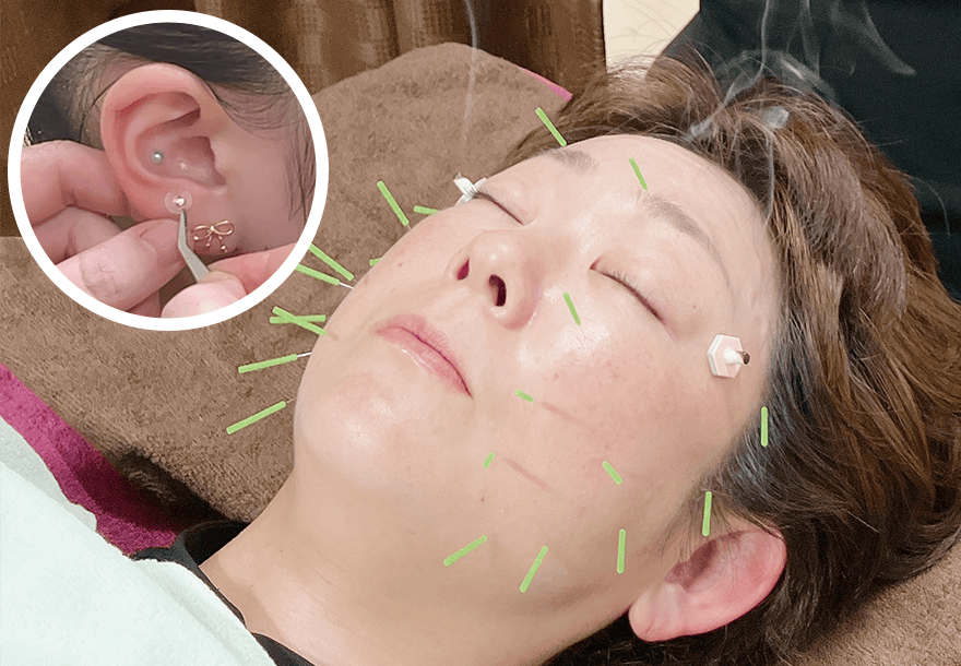 耳つぼ・美容鍼体験